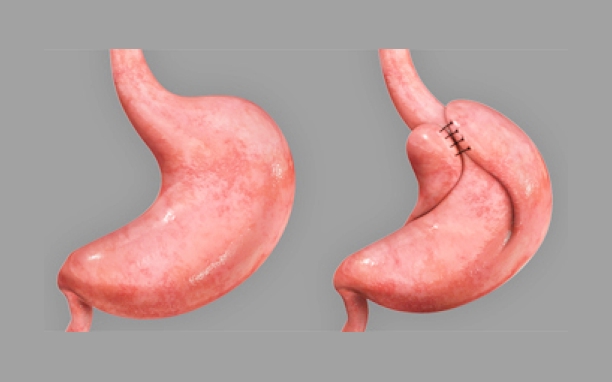 Laparoscopic Fundoplication